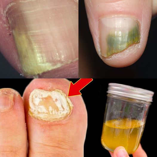 Nail Fungus Removal: 100% Natural Treatment for Toenail Fungus Using Baking Soda