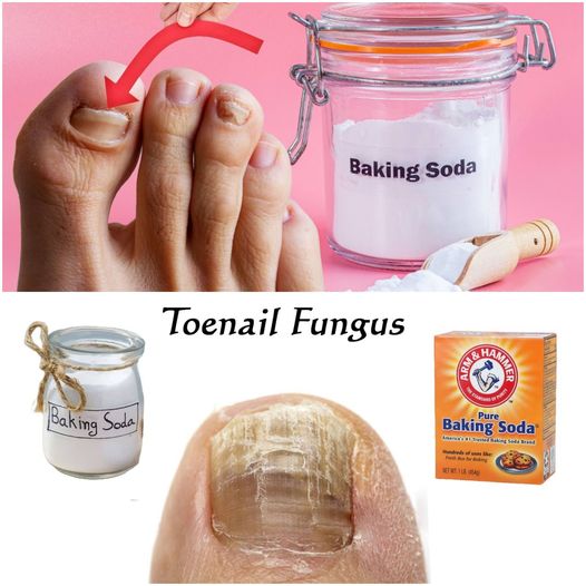 Eliminate Toenail Fungus Naturally with Baking Soda