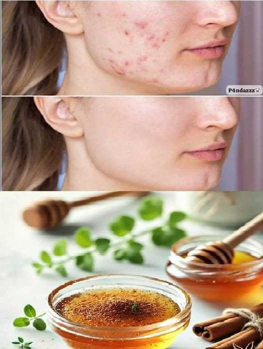 Anti-Acne Honey & Cinnamon Mask