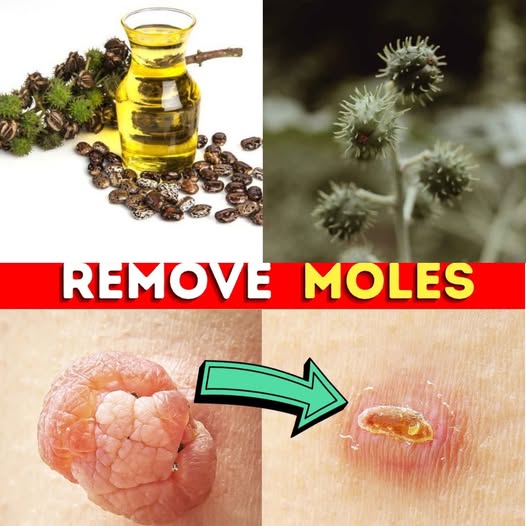 Remove a Mole Naturally and Safely: The Castor Oil Method