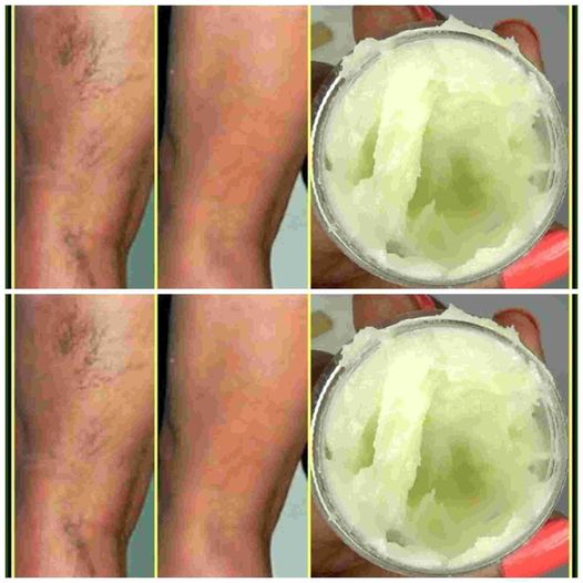 Unveil the Power of Garlic and Baking Soda: A Surprising Natural Remedy for Varicose and Spider Veins