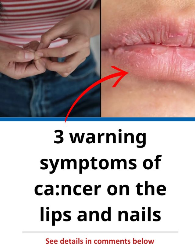 Experts share three warning symptoms of ᴄᴀɴᴄᴇʀ on the lips and nails