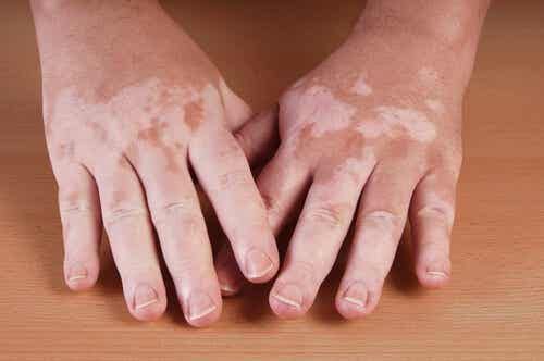 Natural recipe to improve vitiligo with herbs