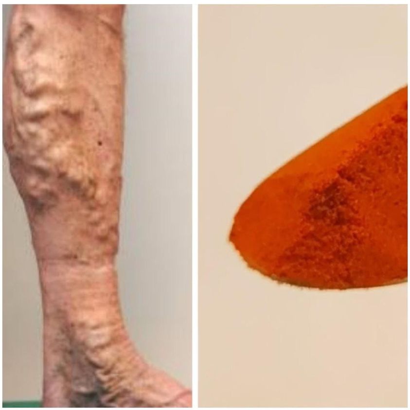 Bid Farewell to Varicose Veins and Boost Circulation Naturally with Cayenne Pepper: The Natural Marvel