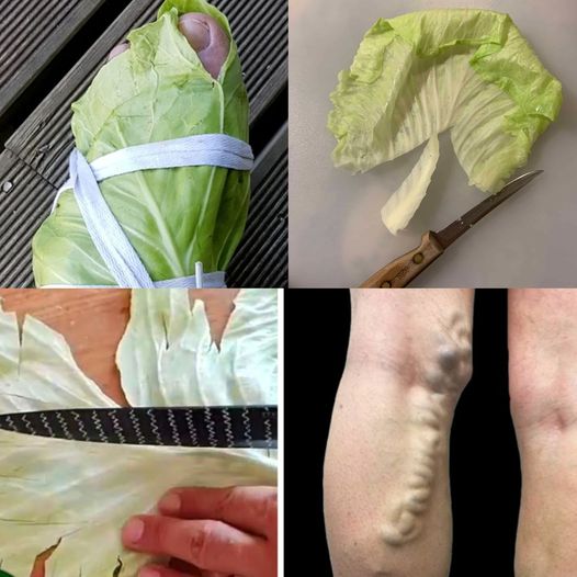 Natural Relief for Varicose Veins: The Healing Power of Cabbage Leaves