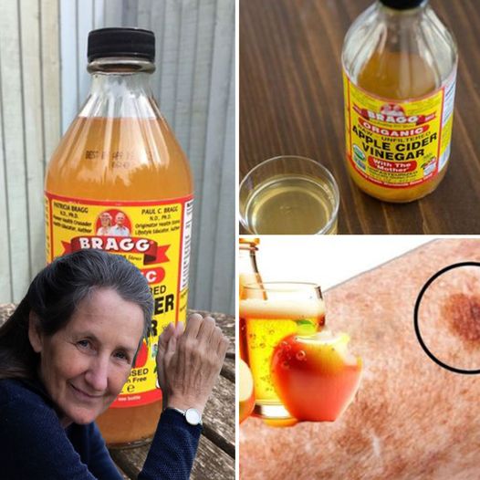 Apple Cider Vinegar Will Remove Age Spots if You Do This