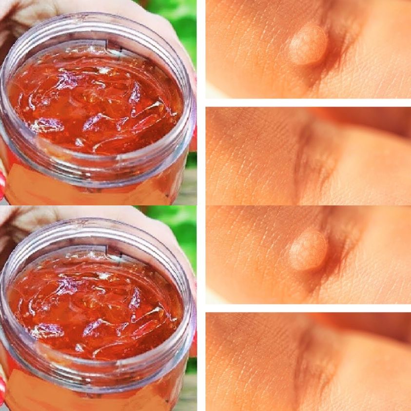 Unveiling the Potency of Apple Cider Vinegar: A Natural Solution for Wart Removal