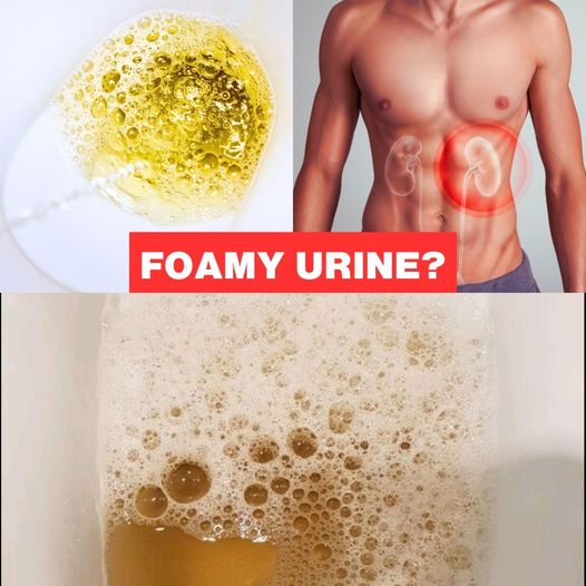 What Does Foamy Urine Mean? Understanding the Warning Sign of Proteinuria