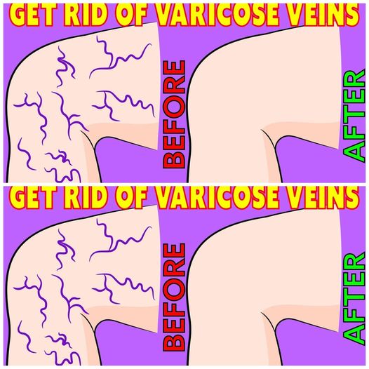 Natural Ways to Reduce Varicose Veins with a Simple Daily Routine