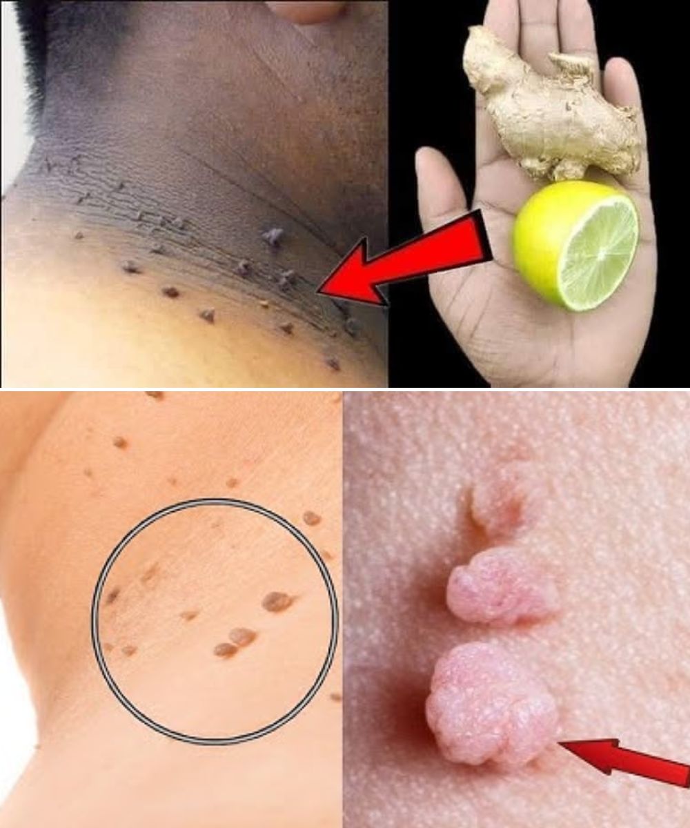 How I Remove Skin Tags at Home with Lemon and Ginger