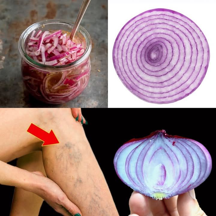 Unbelievable! Red Onion: The Varicose Vein Killer! Erases Varicose Veins Like an Eraser!