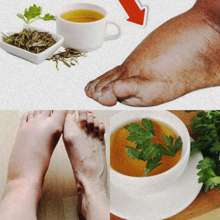 Drink Parsley Tea and Say Goodbye to Swollen Legs, Ankles, and Feet