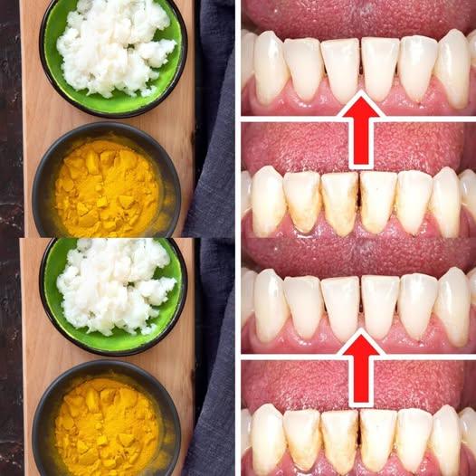 How to Remove Tartar and Plaque from Your Teeth Without a Dentist: Turmeric and Salt