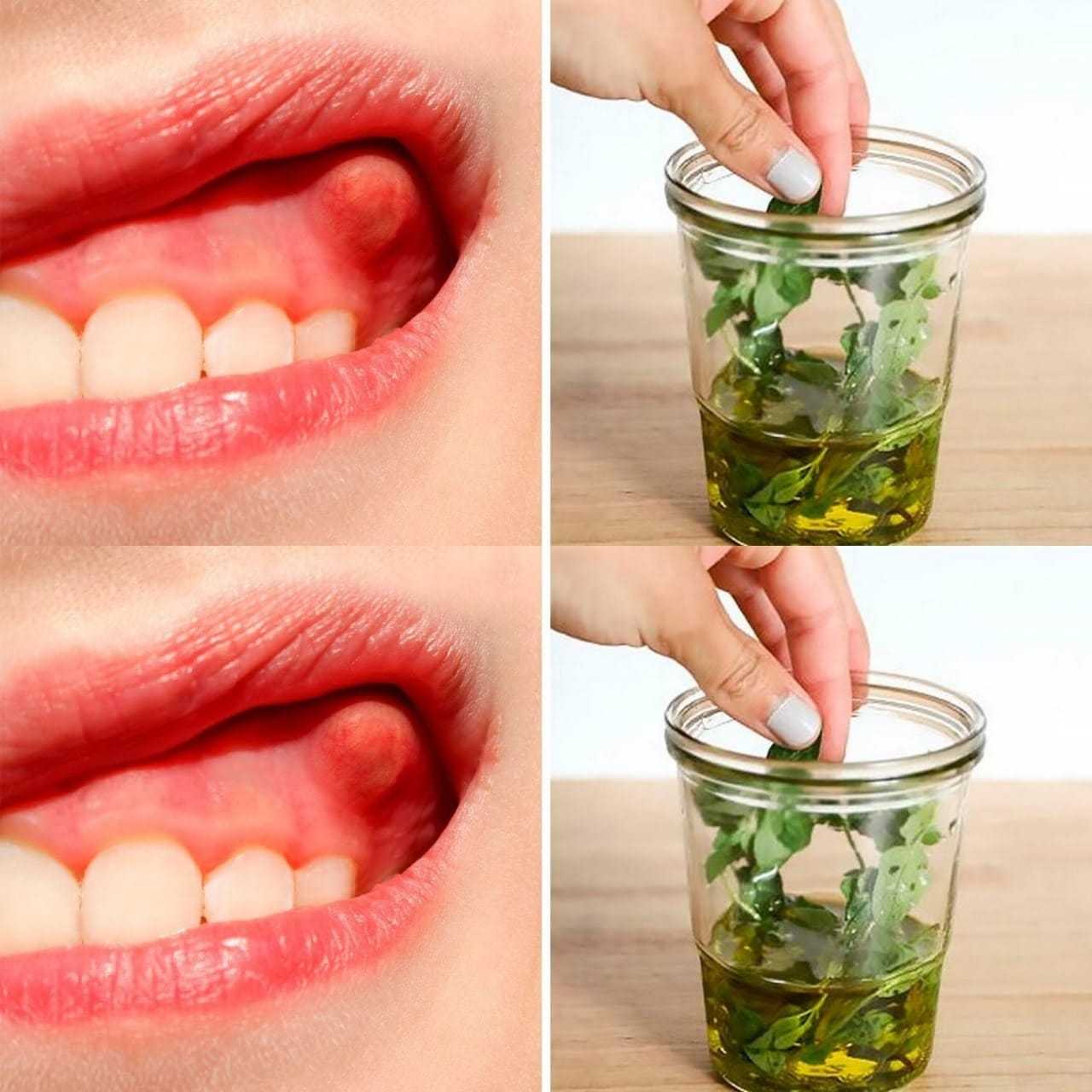 Heal Your Tooth Abscess / Dental Infection Naturally with Oregano Oil