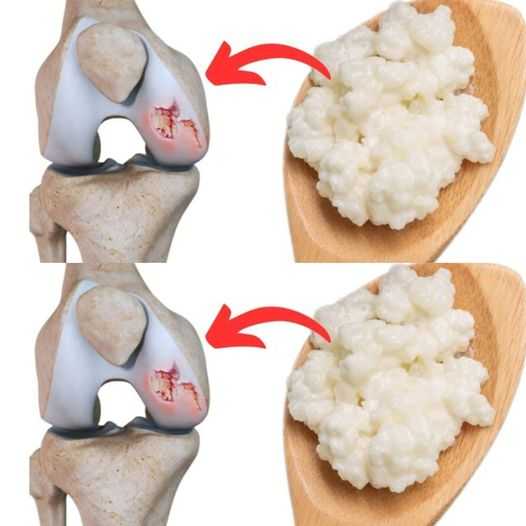 Food for the Renewal of Knee Cartilage: The Benefits of Kefir