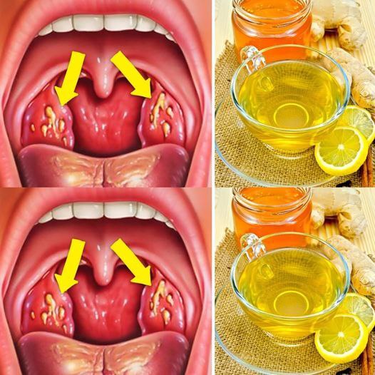 Natural Remedies for Tonsillitis: Soothe Your Throat and Find Relief