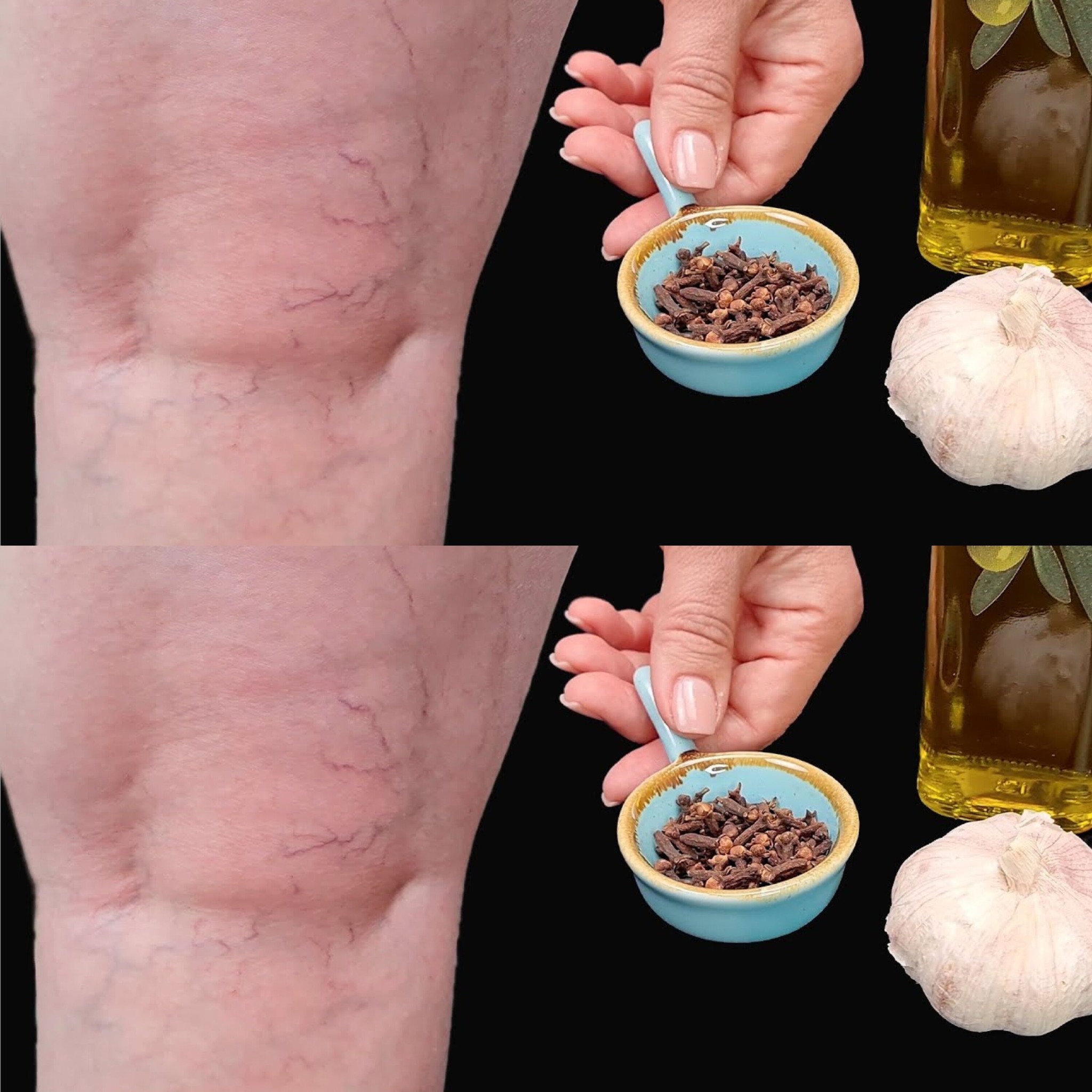 Leg Pain, Rheumatism, Varicose Veins, Arthritis – Natural Remedy with Cloves & Garlic!