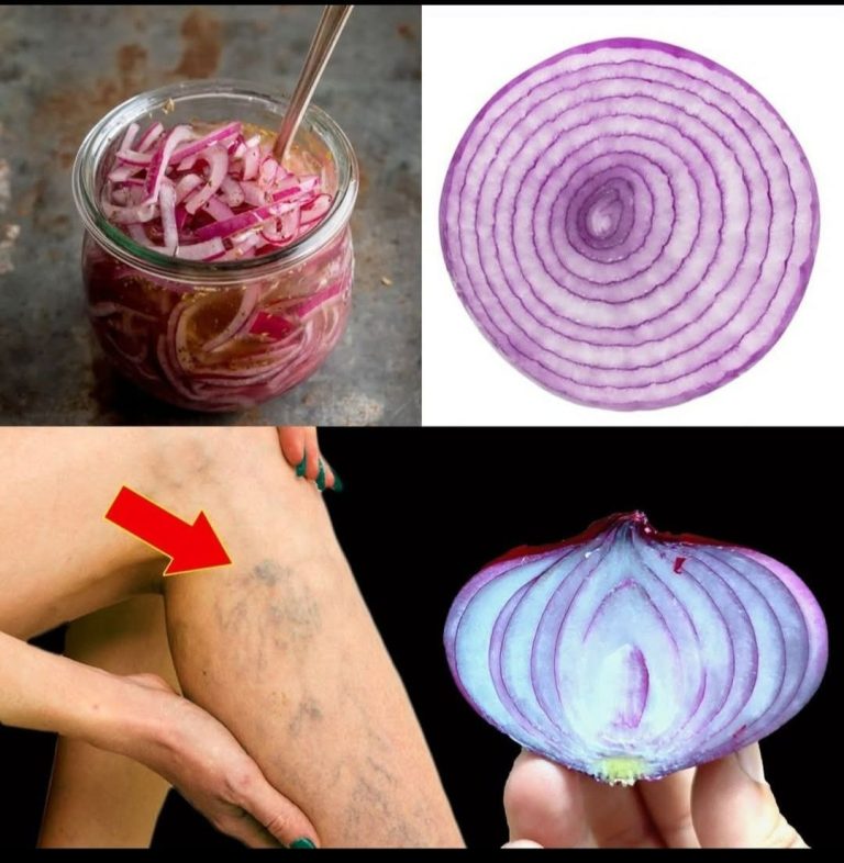 Red Onion: The Varicose Vein Killer!