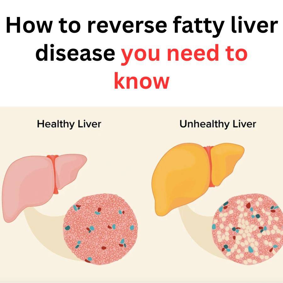 How to reverse fatty liver disease you need to know